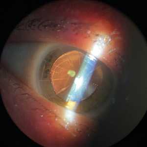 Alcon toric IQ
